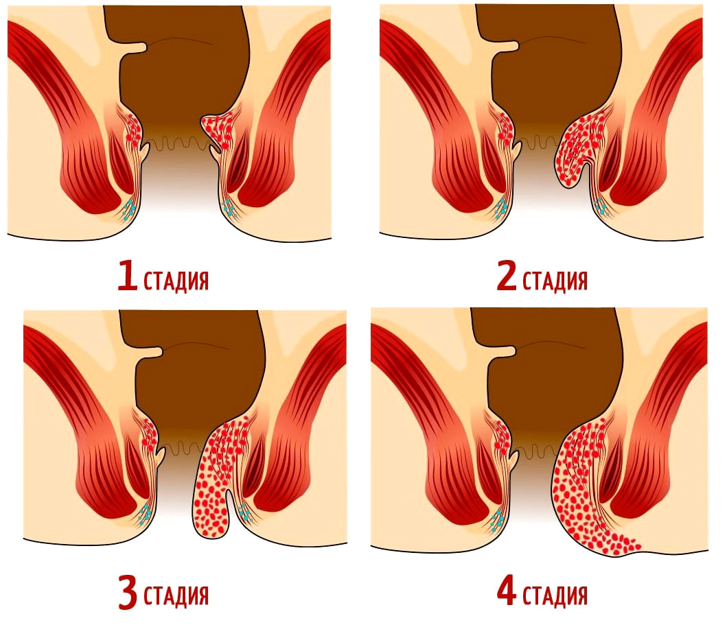 Причины крови из заднего прохода у женщин при дефекации