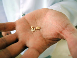 Таблетки от камней в почках: медикаментозное лечение